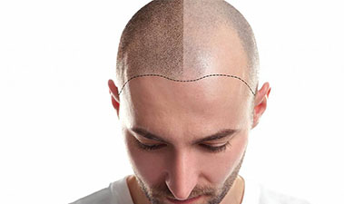 DHI Hair Transplant